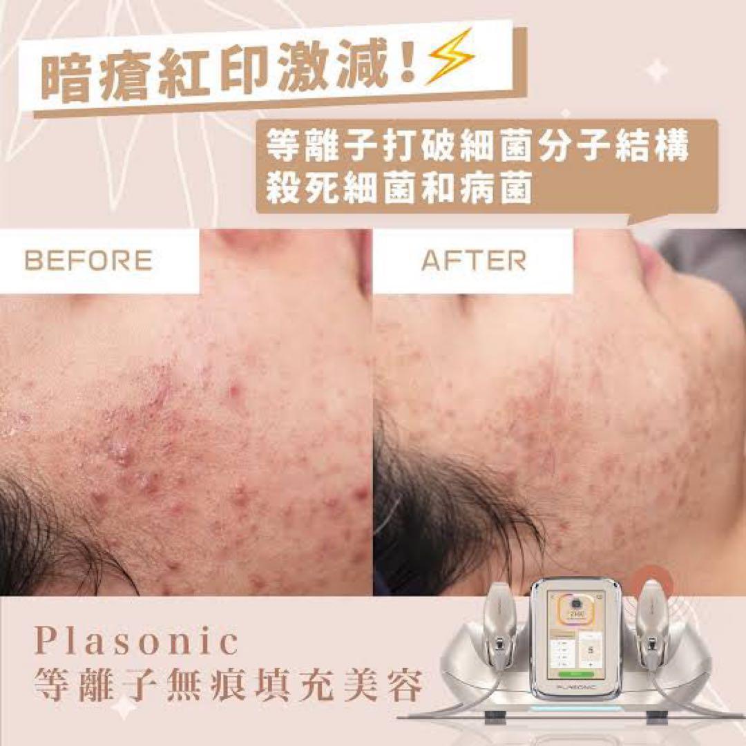 プラズマ plasma 美容　シミ　肝斑　ニキビ　LDM エレクトロポレーション