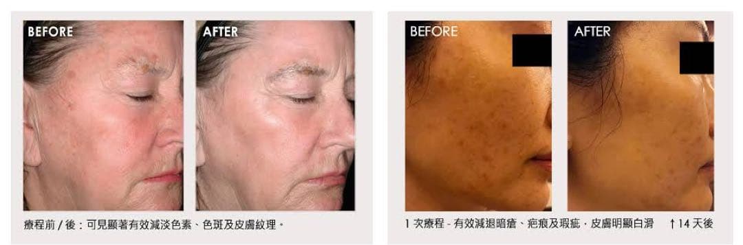 プラズマ plasma 美容　シミ　肝斑　ニキビ　LDM エレクトロポレーション